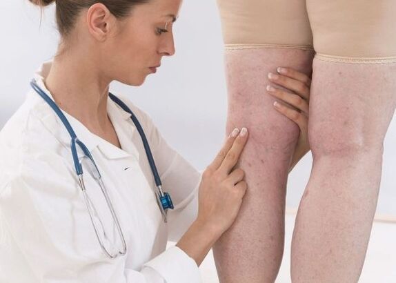 Diagnoza krčnih žil